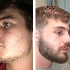 Antes e depois do uso de Minoxidil e suplemento para preencher falhas na barba