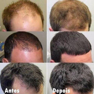 Evolução no crescimento capilar após uso contínuo de Minoxidil Kirkland com suplemento Major