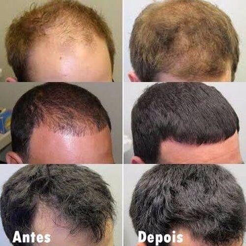 Evolução no crescimento capilar após uso contínuo de Minoxidil Kirkland com suplemento Major